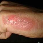 Quase 200 pessoas já foram hospitalizadas por causa de queimaduras neste ano em Campos