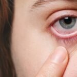 Clima frio e seco aumenta incidência de conjuntivites, diz especialista de Campos